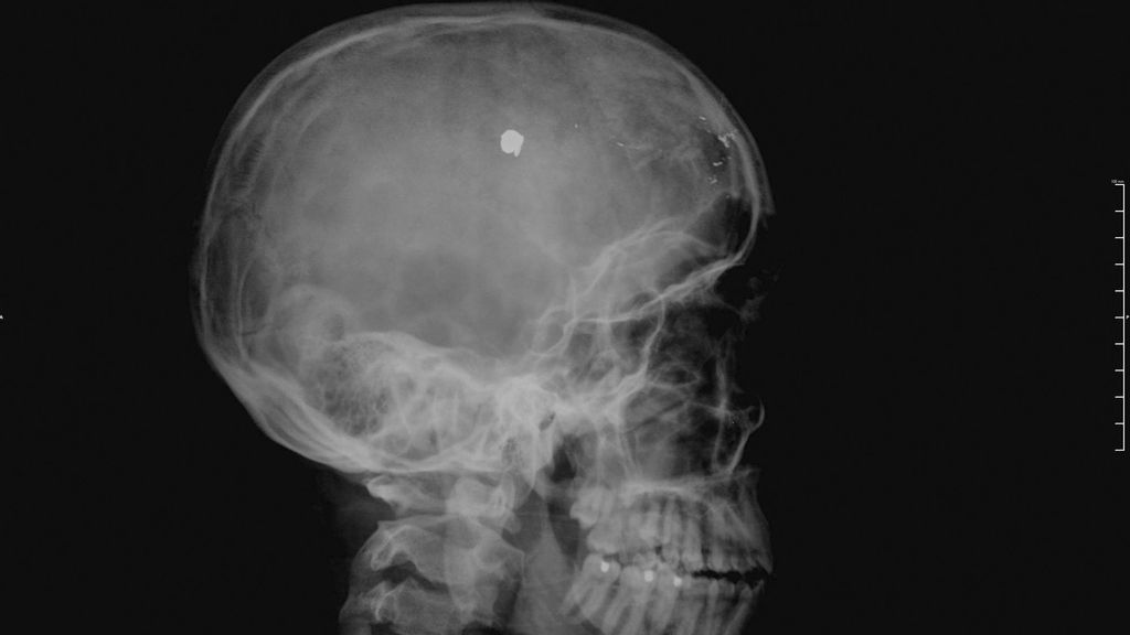 An X-ray shows the bullet lodged in Sebastian Bravo's brain 10 years ago. (Sebastian Bravo/Zenger News)